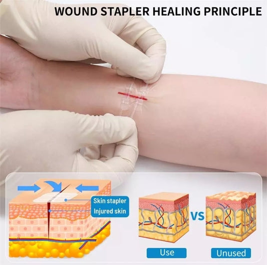 ZipStitch Rapid Suture aplication (No Needle)